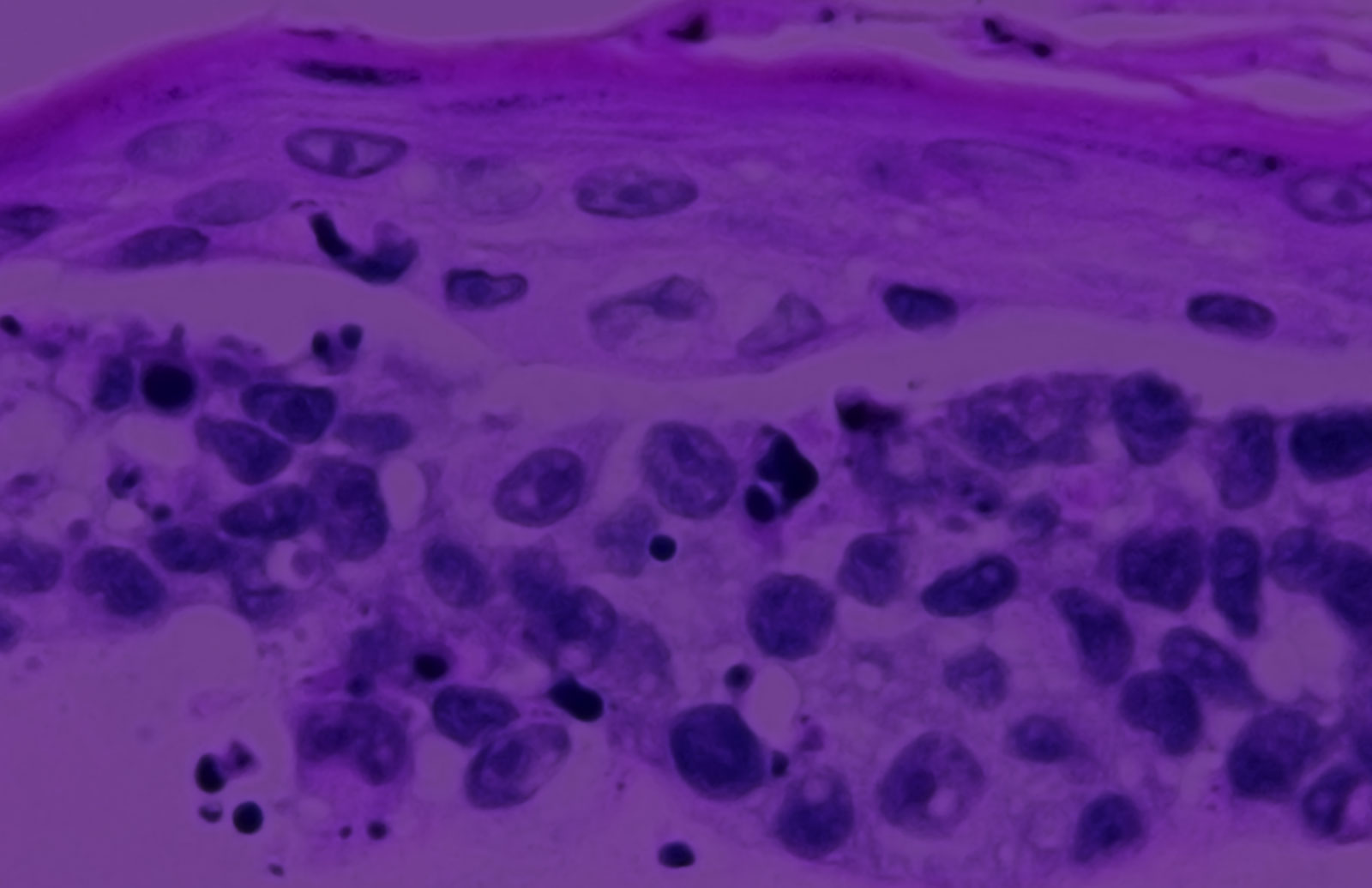 Melanoma